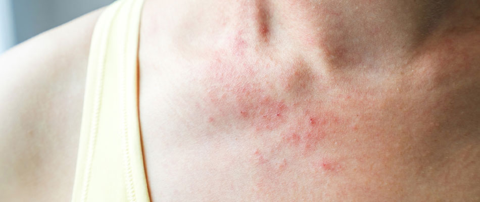 A close-up of a persons upper chest and neck showing red, irritated, patchy skin, possibly due to a rash or an allergic reaction. The person is wearing a light-colored tank top. | California Urgent Care Center