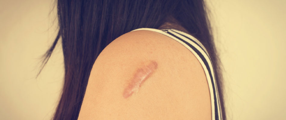 A person with long dark hair faces away, showing a raised, pinkish scar on their upper arm near the shoulder, visible against light skin. They are wearing a sleeveless striped top. | California Urgent Care Center
