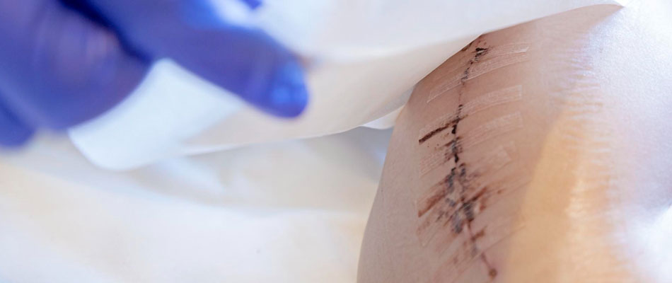 A close-up of a persons leg with a surgical incision held together by adhesive strips. A gloved hand is gently cleaning or caring for the wound. | California Urgent Care Center