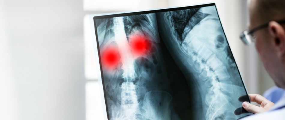 A doctor examines an X-ray image of a chest and neck, with two red spots highlighting areas of concern in the upper chest or throat region. | California Urgent Care Center
